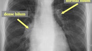 Lung Cancer  Bronchogenic Carcinoma  The most COMPREHENSIVE Explanation [upl. by Htebarual]