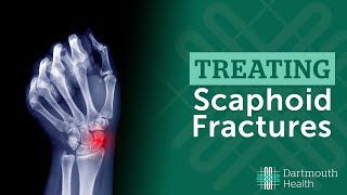 Fracture Healing Part 1  Everything You Need To Know  Dr Nabil Ebraheim [upl. by Septima864]