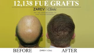 FUE Hair transplant result 12138 Scalp grafts Dr Zarev Bulgaria [upl. by Yc]