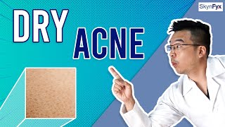 How To Treat Dry Skin  Acne Dry Acne  5 Tips To Follow [upl. by Aniretac248]