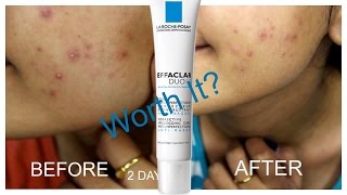 La Roche Posay Effaclar Duo Review  Worth it [upl. by Verna]