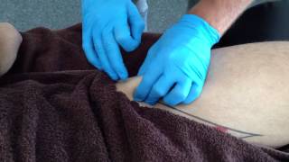 Dry Needling Rectus Femoris [upl. by Araminta]