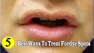 Fordyce Spots on Lips – Treatment How to get rid of them [upl. by Asirehc859]