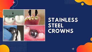 PEDIATRIC DENTISTRY  STAINLESS STEEL CROWNS [upl. by Camilo31]