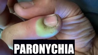 Paronychia  Katuruturu  home remedy and treatment [upl. by Htur773]