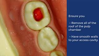 Pulpotomy of Deciduous Molar  QMUL [upl. by Floria]