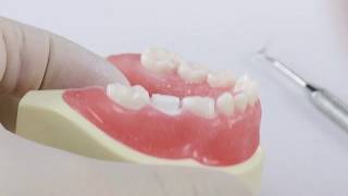 Pediatric Zirconia Crown Technique  Posterior [upl. by Ilehs]