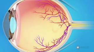 What causes a macular pucker [upl. by Sneve486]