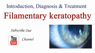 Filamentary Keratopathy  Keratitis Introduction Causes Diagnosis and Treatment  Optometry Club [upl. by Aihsiyt]