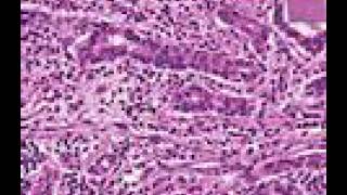 Cholecystitis vs Cholelithiasis vs Cholangitis vs Choledocolithiasis [upl. by Eiramlatsyrk]