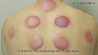 What You Need to Know about Cupping [upl. by Nyladnar]