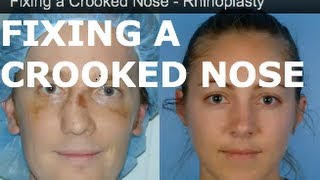 Fixed a Crooked Nose – Rhinoplasty in San Francisco – Dr David Kim [upl. by Atolrac]