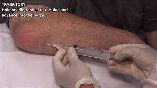 Olecranon Bursitis  Aspiration and Injection  In Vivo Series [upl. by Filahk]