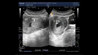 How To Female Pelvis Ultrasound Exam 3D Video [upl. by Sauer243]