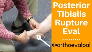 Posterior Tibialis Rupture Evaluation [upl. by Jonah]