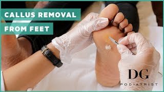 Callus removal from feet balls of feet [upl. by Hokanson]