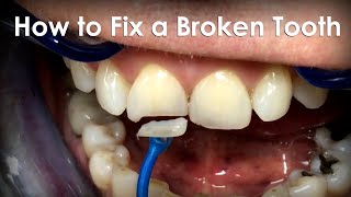 How to Fix a Broken Tooth Using Monolithic Press [upl. by Meriel496]