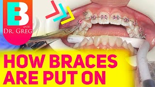 Getting Braces 101  Putting Braces On [upl. by Marven]