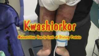 Kwashiorkor [upl. by Hewitt]