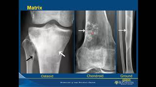 Imaging of Bone Tumors [upl. by Assylla]