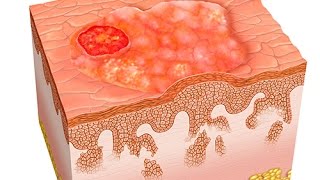 Questce quun carcinome [upl. by Novit]