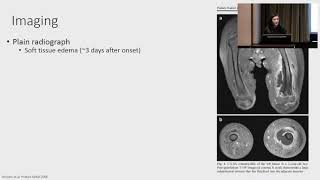 Chronic osteomyelitis [upl. by Rasure748]