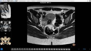 Female Pelvis MRI [upl. by Rossy]