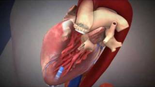 Percutaneous Valve Repair Procedure [upl. by Allie]