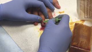 Pediatric Nailbed Laceration [upl. by Emmie623]