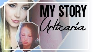 My Story Urticaria Chronic Idiopathic Hives [upl. by Obrien]