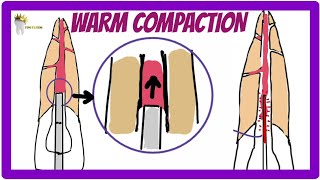 ENDODONTICS  OBTURATION TECHNIQUES  Warm Vertical Compaction technique [upl. by Bower]