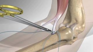 Distal Biceps Repair with Arthrex® Tension Slide [upl. by Eanahs]