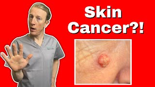 Squamous Cell Skin Cancer SCC  What You Need to Know for Early Detection and Treatment [upl. by Tessa]