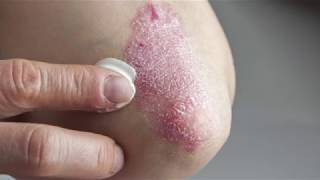 Understanding what causes eczema [upl. by Ramyaj]