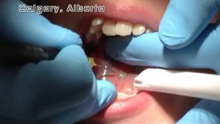 Laser Posterior Tongue Tie Revision in Calgary Alberta [upl. by Ardnwahs96]