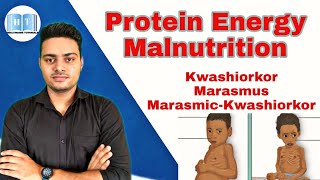 Protein Energy Malnutrition  Kwashiorkor Vs Marasmus [upl. by Sheelah235]