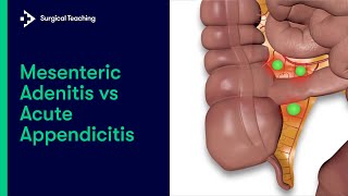 Mesenteric Adenitis vs Appendicitis  How to tell the difference [upl. by Asha]