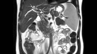 Primary Sclerosing Cholangitis PSC [upl. by Auhesoj]