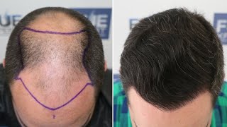 FUE Hair Transplant 4766 Grafts NW V By Dr Juan Couto  FUEXPERT CLINIC Madrid Spain [upl. by Smada]