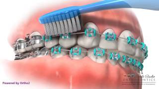 Proper Brushing Technique  Braces [upl. by Renae]