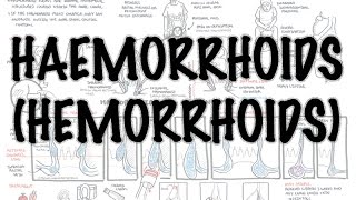 Haemorrhoids Hemorrhoids  Overview pathophysiology investigations and treatment [upl. by Elletnuahs]