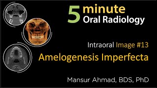 Amelogenesis imperfecta Intraoral Radiographic Interpretation [upl. by Enyalb607]