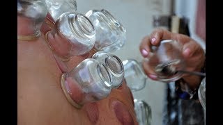 Cupping Pain Therapy [upl. by Gehlbach]