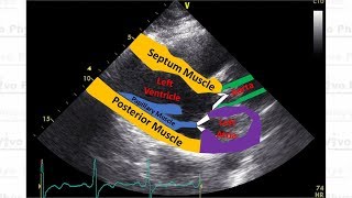 Supraventricular Arrhythmias by C LaGrasta  OPENPediatrics [upl. by Nrehtac]