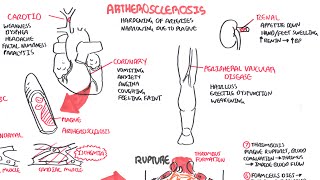 Atherosclerosis  Pathophysiology [upl. by Aramal]