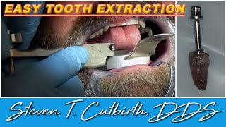 Easy Tooth Extraction  Dental Minute with Steven T Cutbirth DDS [upl. by Notnirb291]