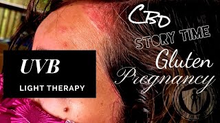 UVB Light Therapy in Dermatitis Treatment StoryTime [upl. by Ydnirb]