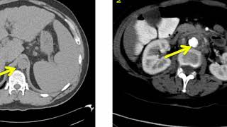 Introduction to Radiology Computed Tomography [upl. by Aerdnaeel231]