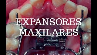 BRACKETS  EXPANSORES MAXILARES  Hyrax  QuadHelix  McNamara [upl. by Larrabee]