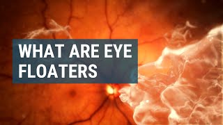 What Are Eye Floaters [upl. by Lorrad603]